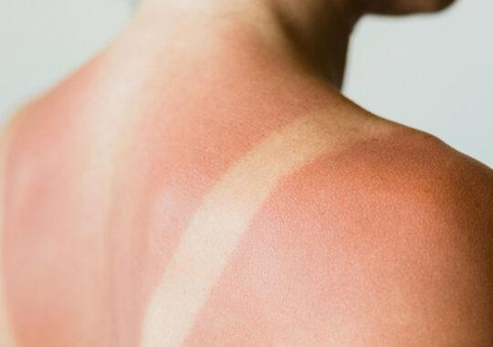 Tattoos und Sonnenbrand