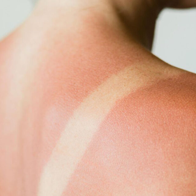 Tattoos und Sonnenbrand